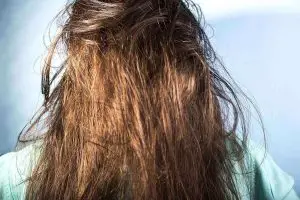 What are the causes of oily hair?
