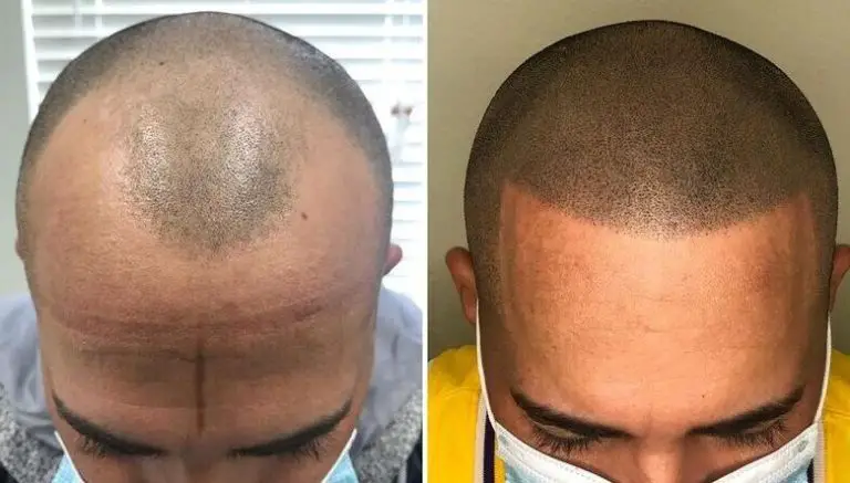 Get Creative with Scalp Micro Pigmentation