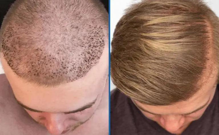 Is There Any Hair Transplant Method Better Than The FUE Method?